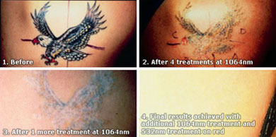Tattoo Removal - ExpressCare Guam Clinic
